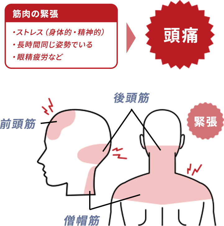 筋緊張型頭痛