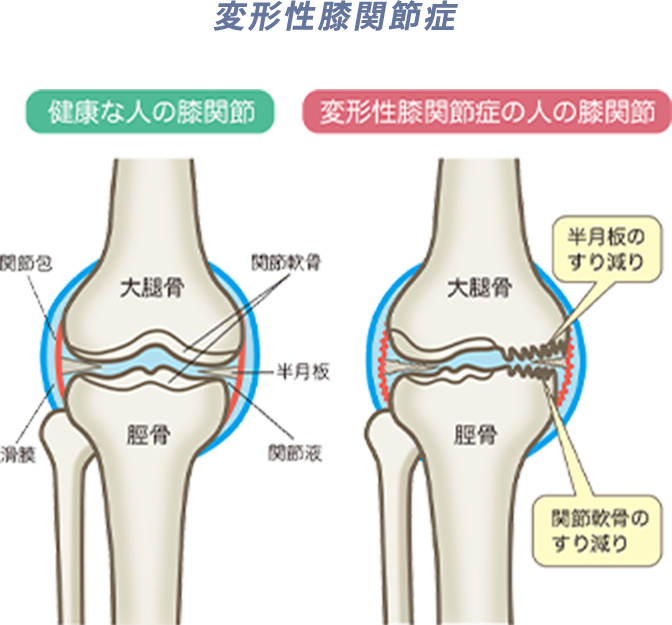 変形性膝関節症
