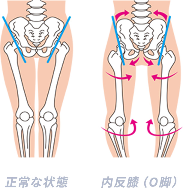 骨盤の正常な状態と内反膝（O脚）